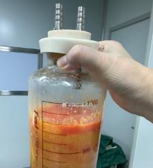 甘肃水动力吸脂手术要做多久？